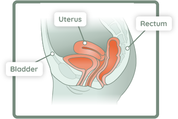 Pelvic Organ Prolapse (POP)  Southern Urogynecology Wellness